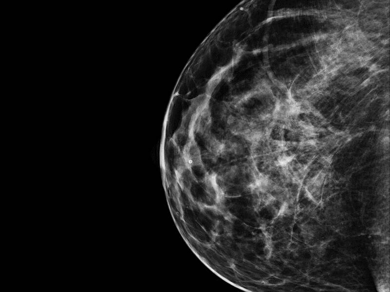 Breast screening with 3D imaging is better at finding cancer than regular scans alone.